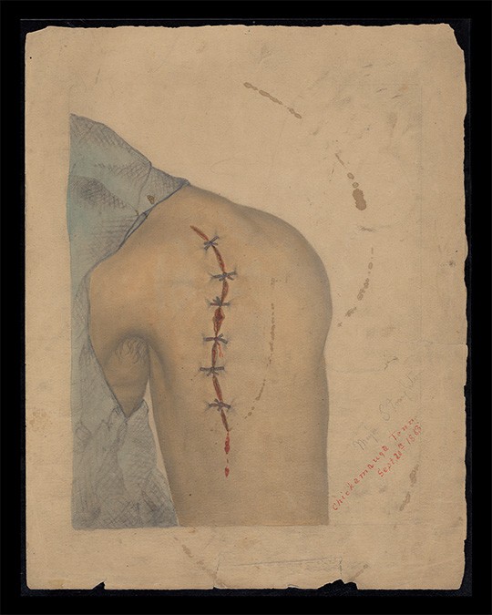 shoulder stitches. daniel s. young medial illustration